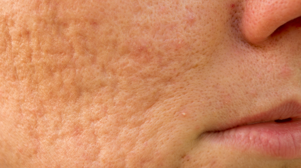 The Physician’s Guide to Getting Rid of Acne Scars—Safely and Effectively