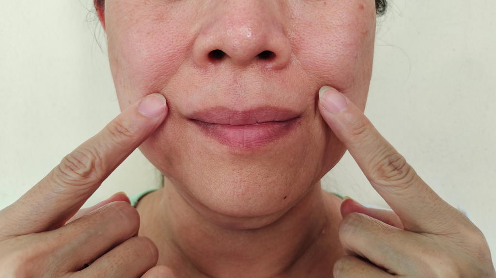 What’s the Best Way to Treat Smile Lines—Botox or Filler?
