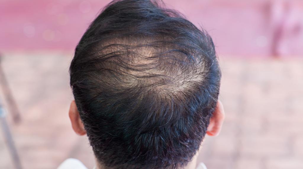 How to Regrow Thinning Hair: A Physician’s Guide to What Actually Works