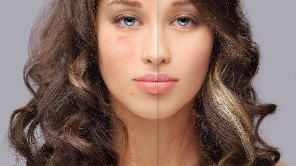 Understanding Acne Scars: Exploring Causes, Treatment Strategies, and Acne Scar Science