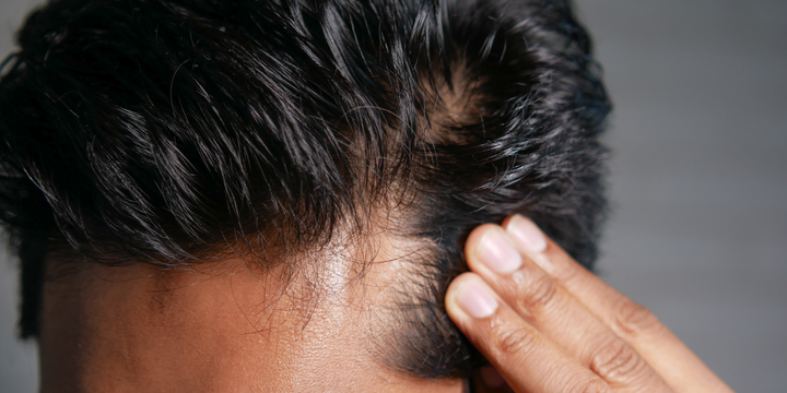 Exosome Hair Restoration Package at MD Skin Lab