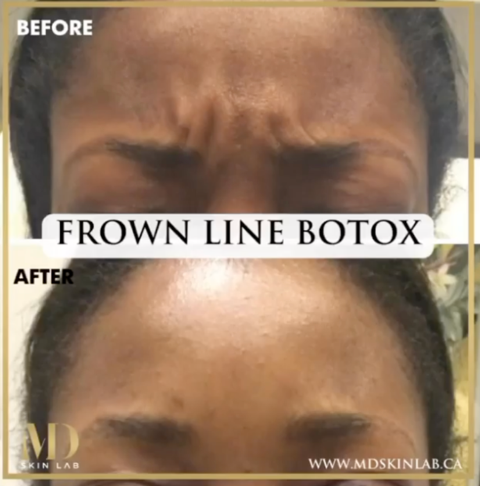 Botox Injections – MD Skin Lab Canada